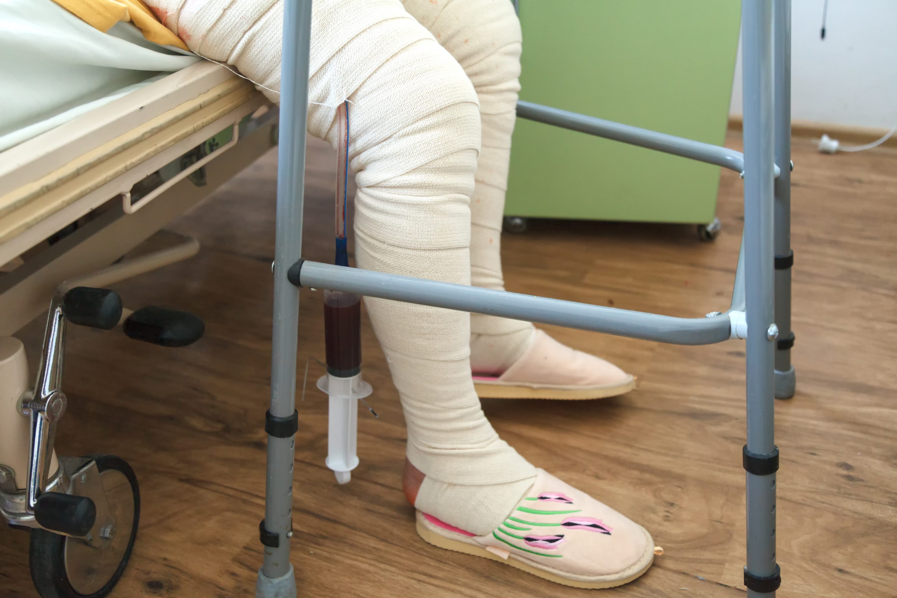 A person sitting on a hospital bed with heavily bandaged legs, using a walker for support. Perfect for illustrating the role of expert witnesses in personal injury cases