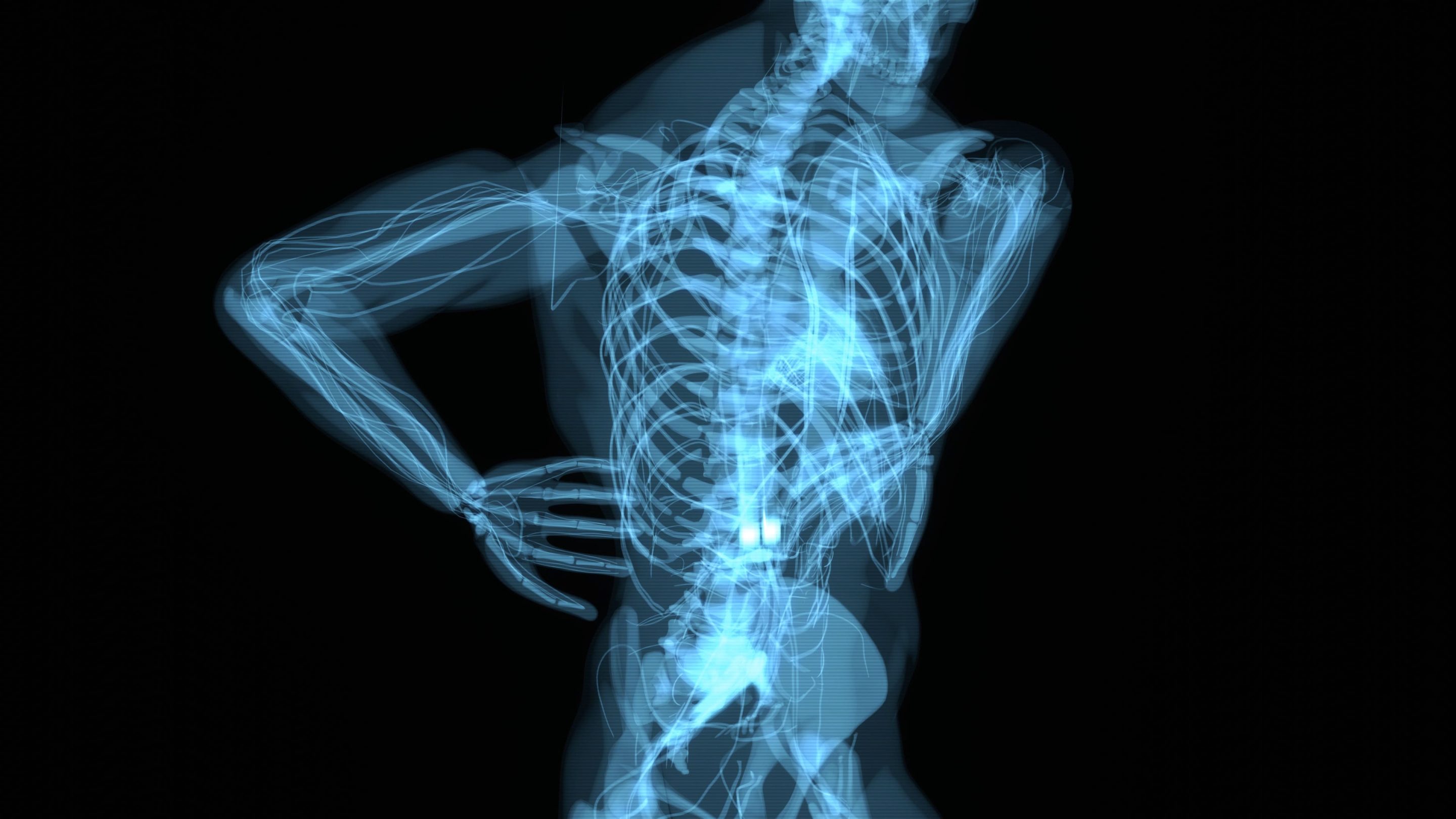 3D skeletal rendering of a back injury, illustrating medical evidence for spinal cord trauma, lumbar disc herniation, and personal injury litigation damages